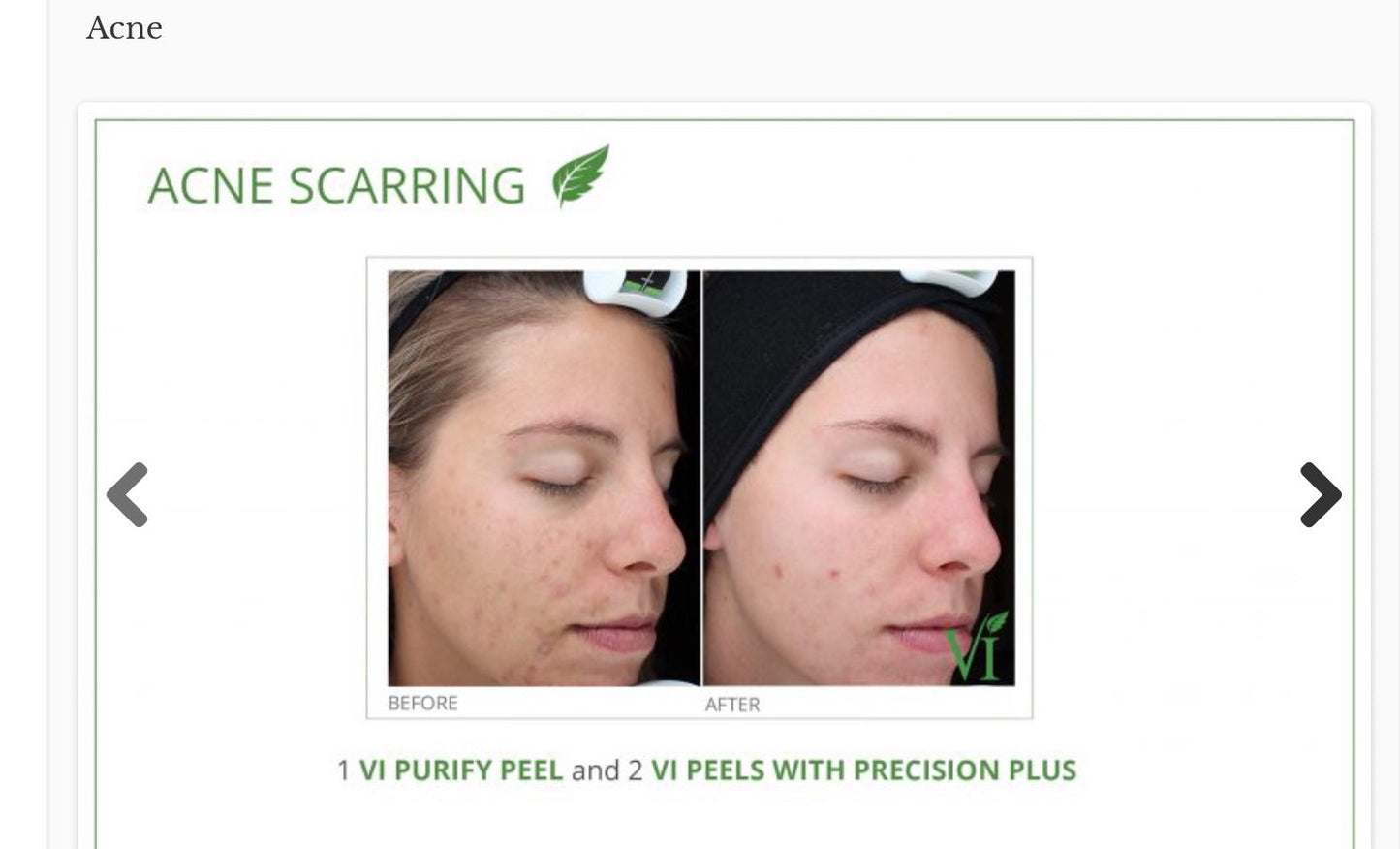 VI Peel Purify with Precision plus kit Exp.07/2026