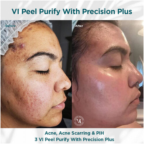 VI Peel Purify with Precision +Peptides Full kit Exp.2027