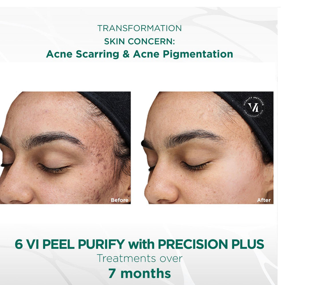 VI Peel Purify with Precision plus kit Exp.07/2026